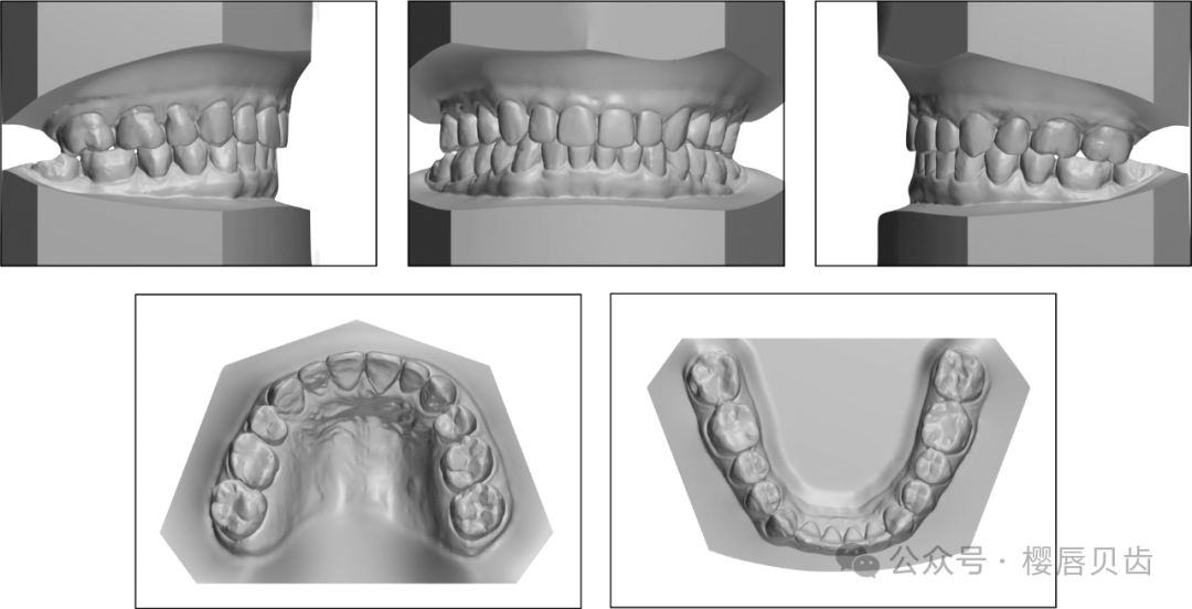 Using Modified Double J Retainers for Class II Correction