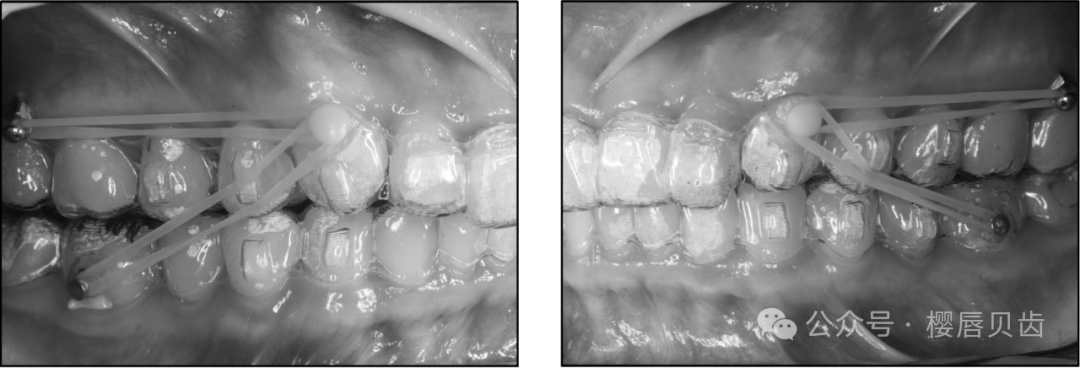 Using Modified Double J Retainers for Class II Correction