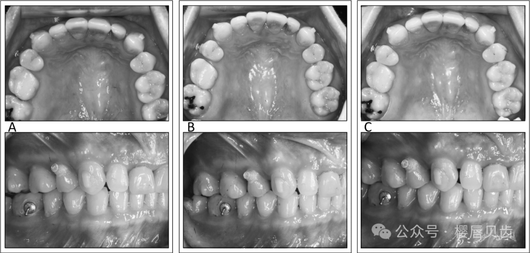 Using Modified Double J Retainers for Class II Correction