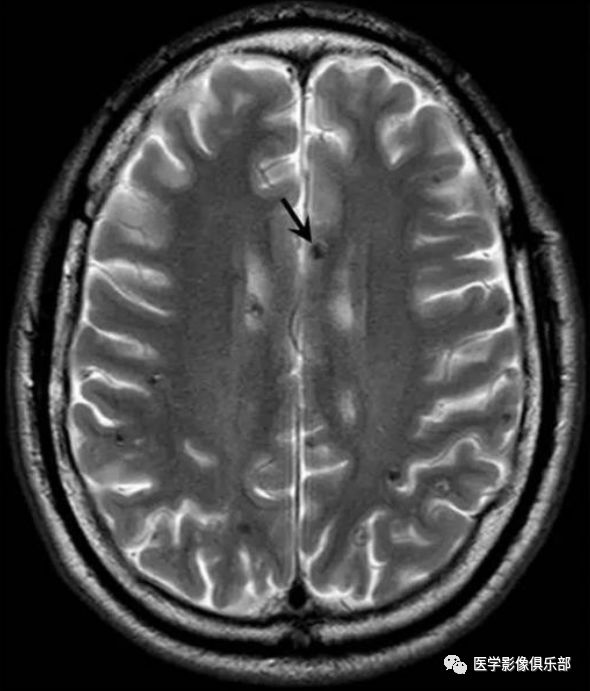 Cerebral Cysticercosis: A Comprehensive Overview