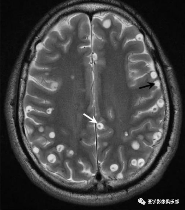 Cerebral Cysticercosis: A Comprehensive Overview