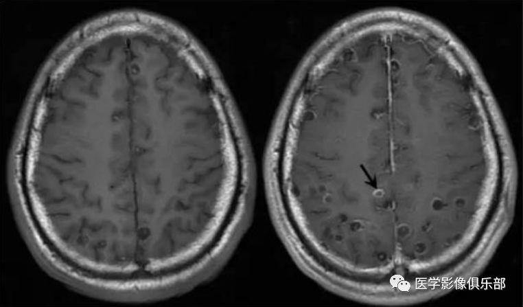 Cerebral Cysticercosis: A Comprehensive Overview