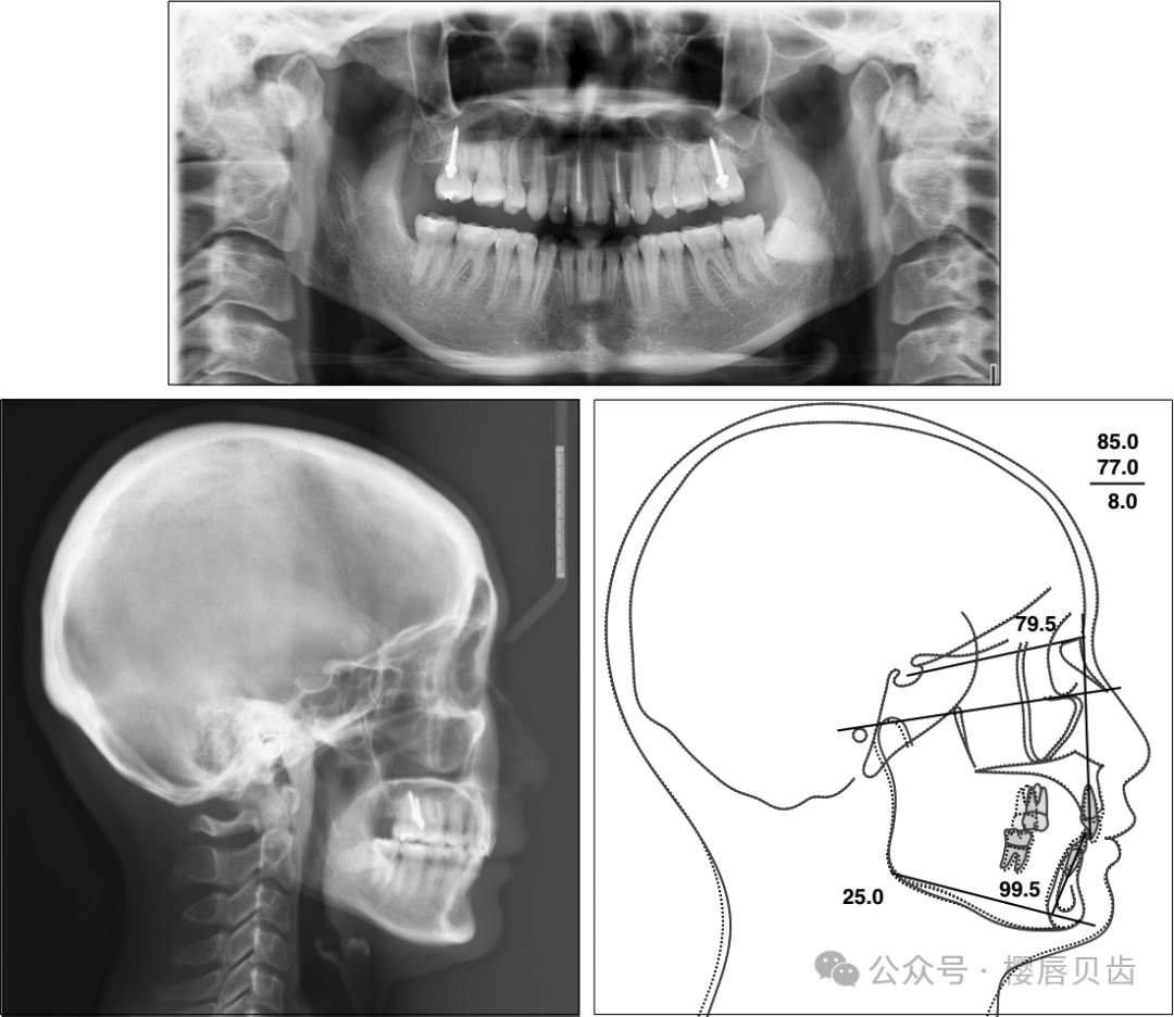 Using Modified Double J Retainers for Class II Correction