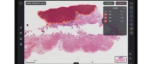 In-Depth Imaging: A Pathology Diagnosis System Based on TensorFlow