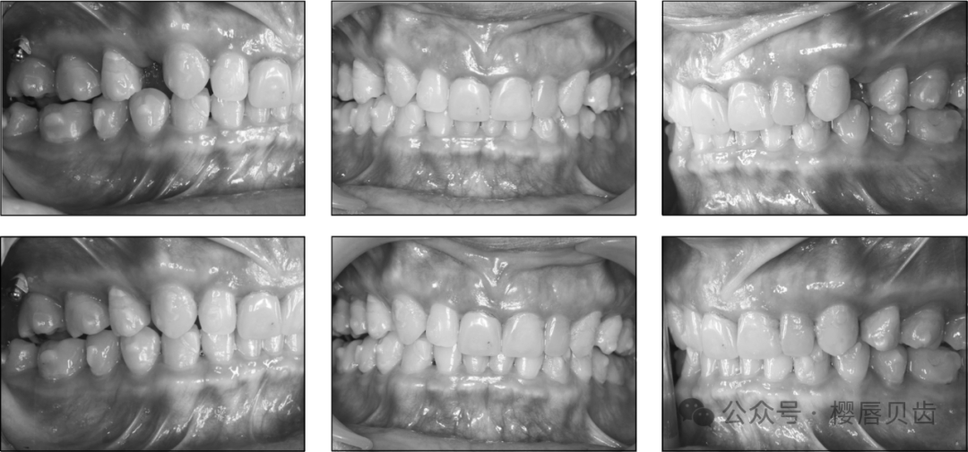 Using Modified Double J Retainers for Class II Correction