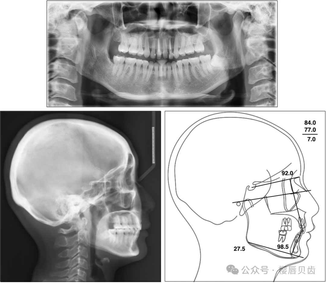 Using Modified Double J Retainers for Class II Correction