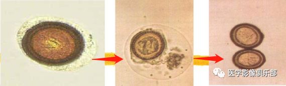 Cerebral Cysticercosis: A Comprehensive Overview