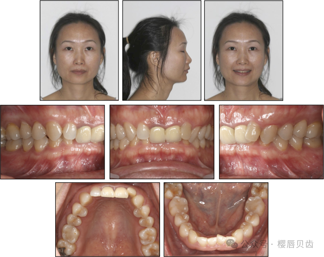 Using Modified Double J Retainers for Class II Correction