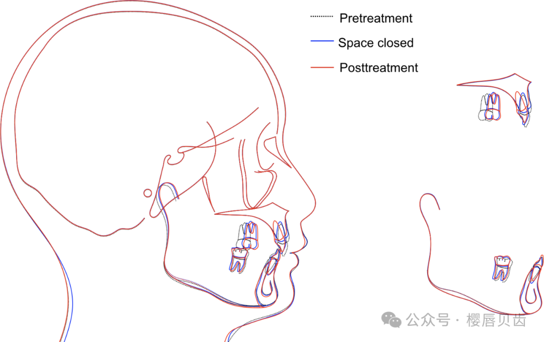 Using Modified Double J Retainers for Class II Correction