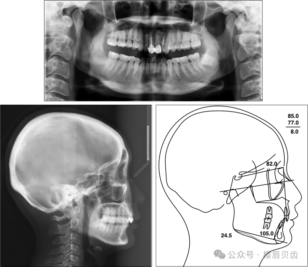 Using Modified Double J Retainers for Class II Correction