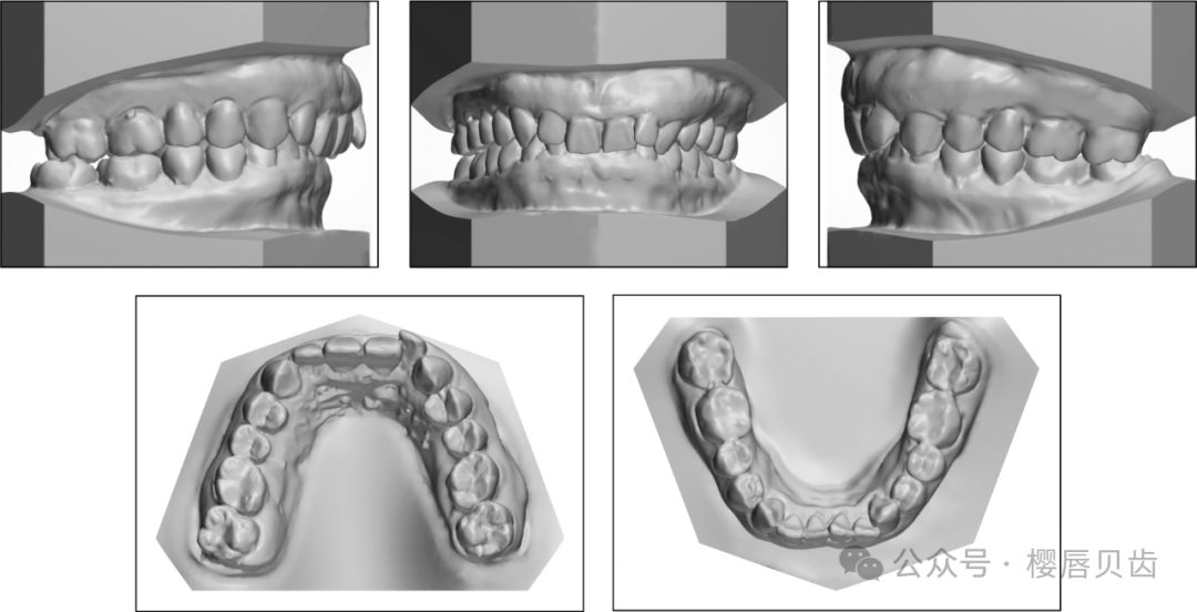 Using Modified Double J Retainers for Class II Correction