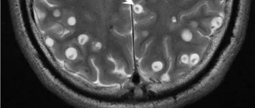 Cerebral Cysticercosis: A Comprehensive Overview