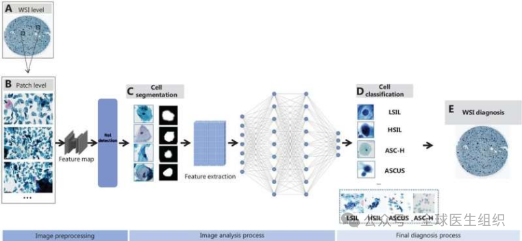 AI Software Enhances Cervical Cancer Detection Through Medical Imaging