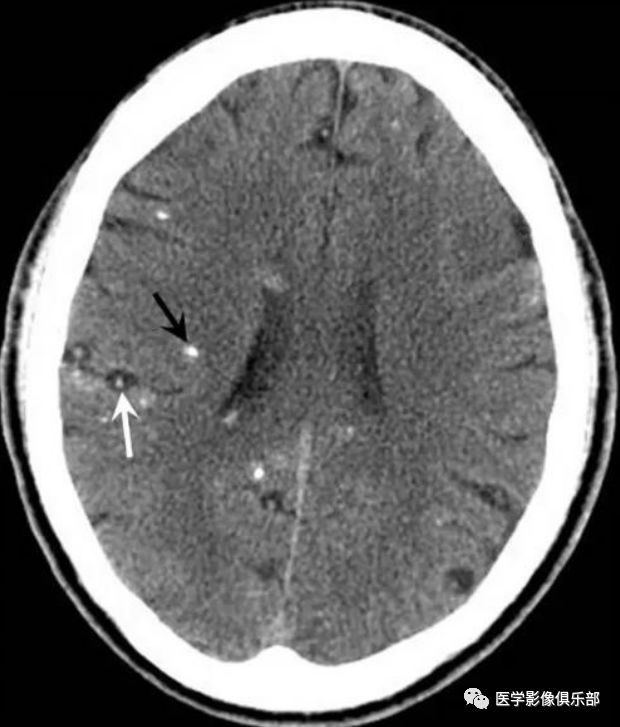 Cerebral Cysticercosis: A Comprehensive Overview