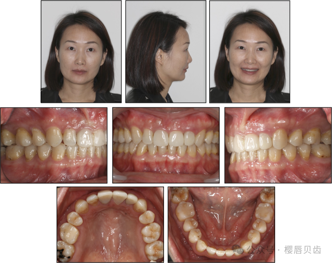 Using Modified Double J Retainers for Class II Correction