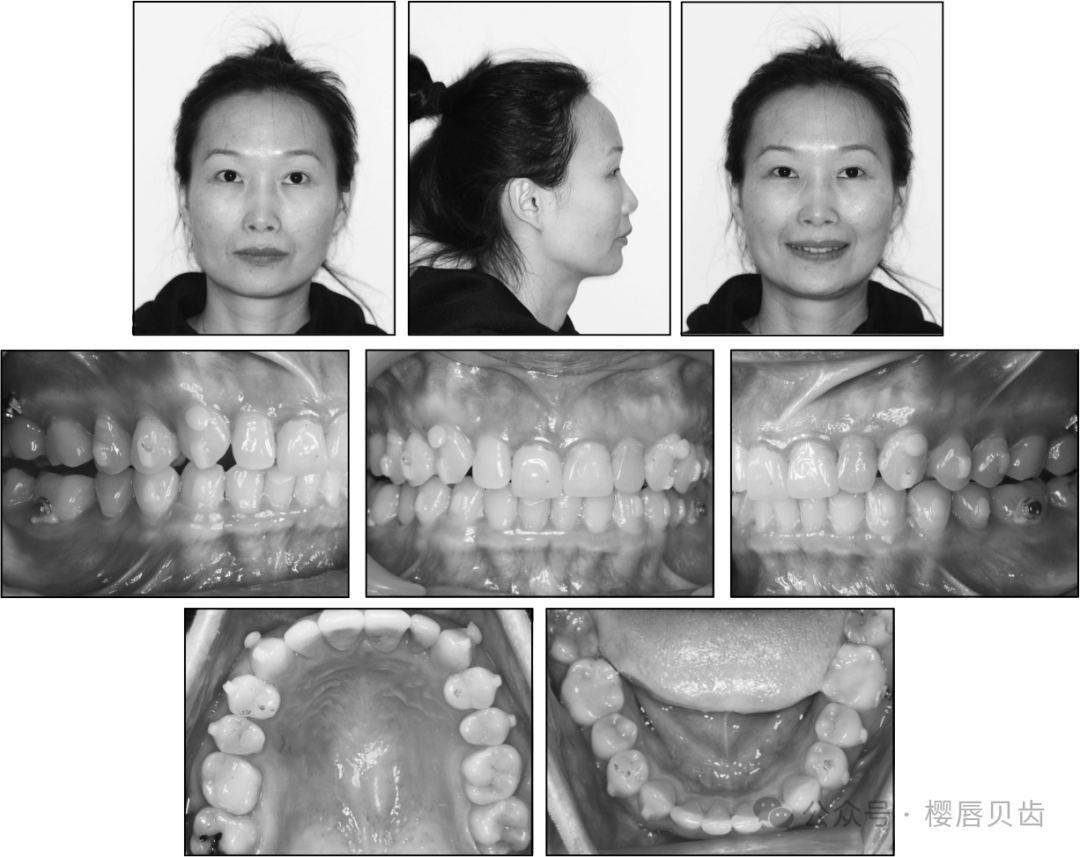 Using Modified Double J Retainers for Class II Correction