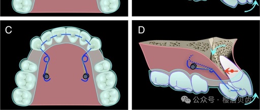 Using Modified Double J Retainers for Class II Correction