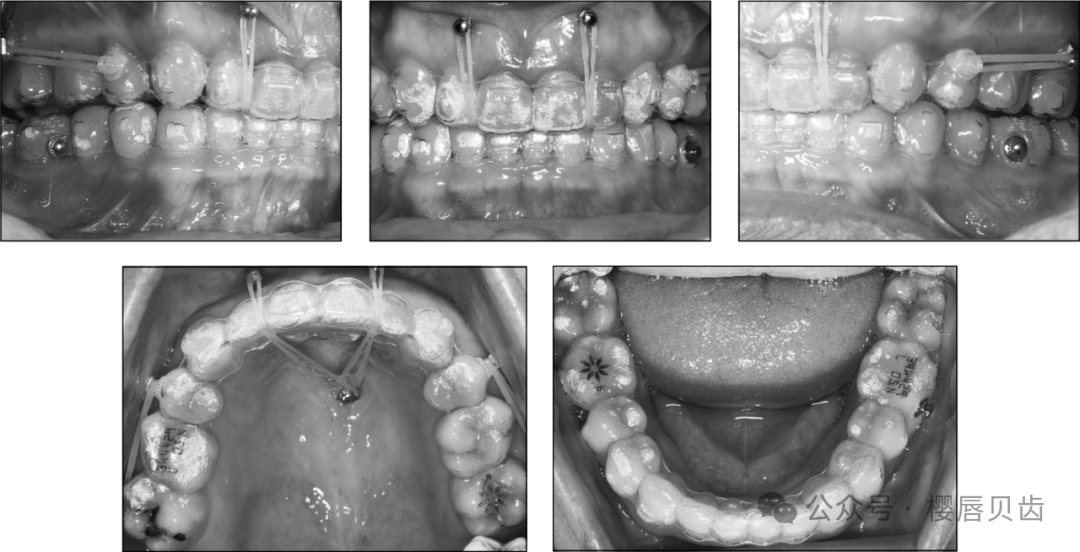 Using Modified Double J Retainers for Class II Correction