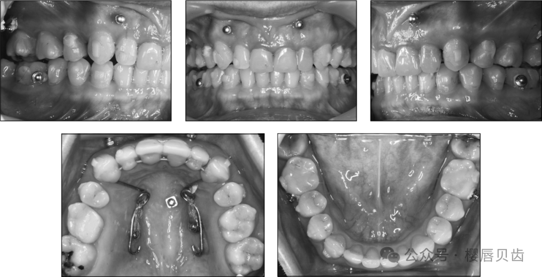 Using Modified Double J Retainers for Class II Correction