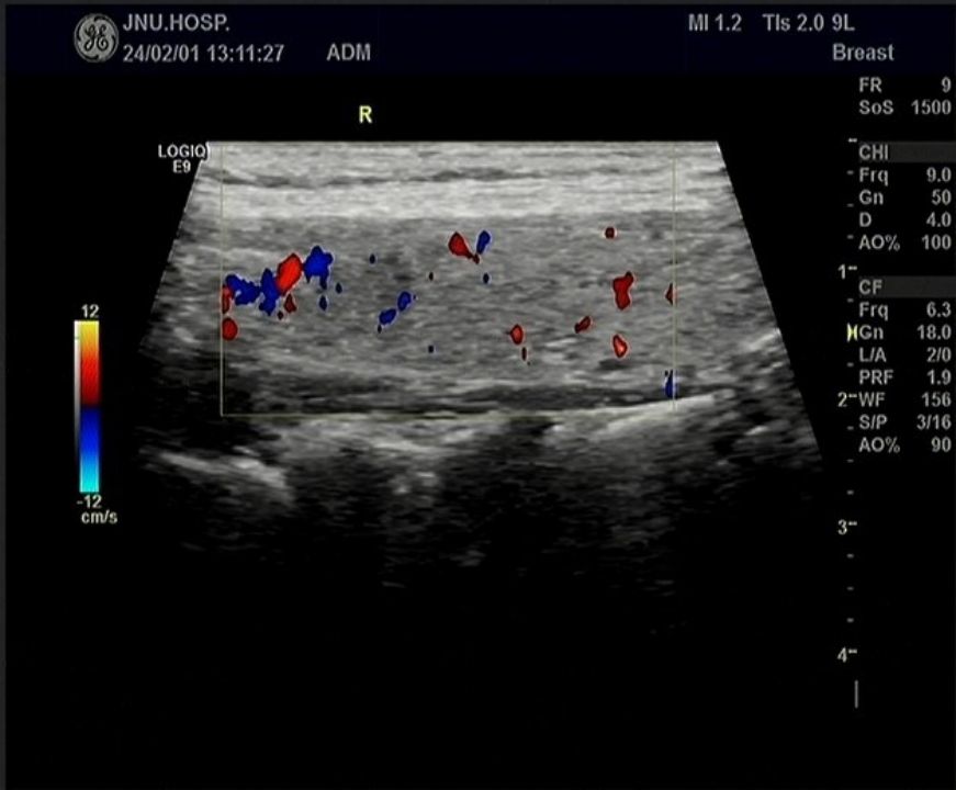 Multimodal Ultrasound Evaluation of Thyroid Nodules