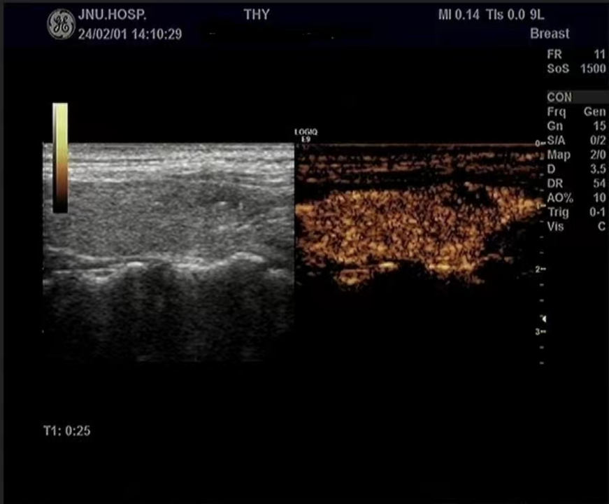 Multimodal Ultrasound Evaluation of Thyroid Nodules