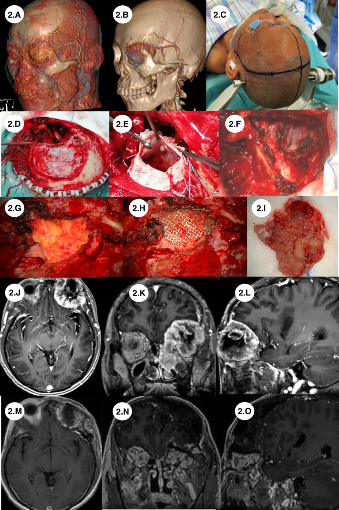 Application of Preoperative Multimodal Imaging Fusion Technology in Complex Skull Base Tumor Surgery