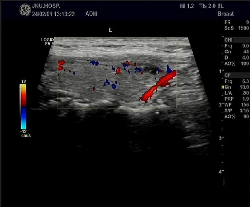Multimodal Ultrasound Evaluation of Thyroid Nodules