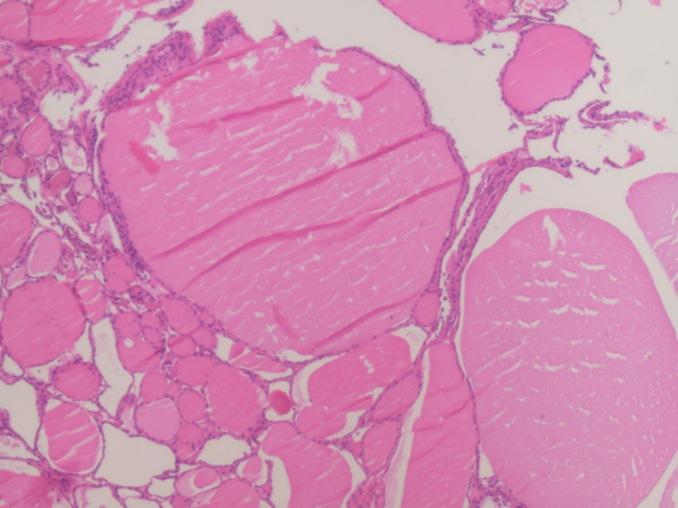 Multimodal Ultrasound Evaluation of Thyroid Nodules