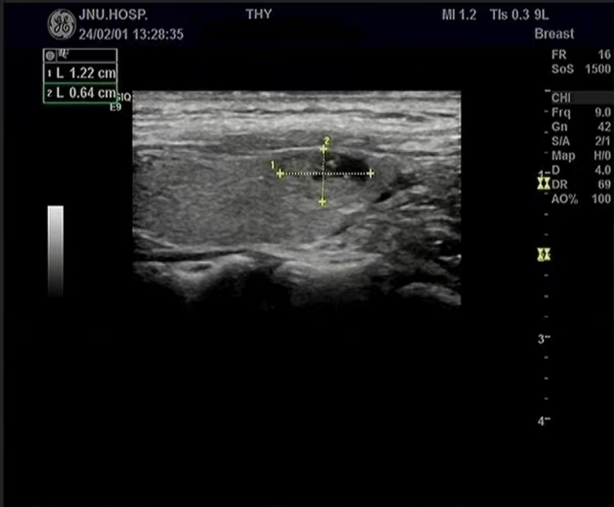 Multimodal Ultrasound Evaluation of Thyroid Nodules
