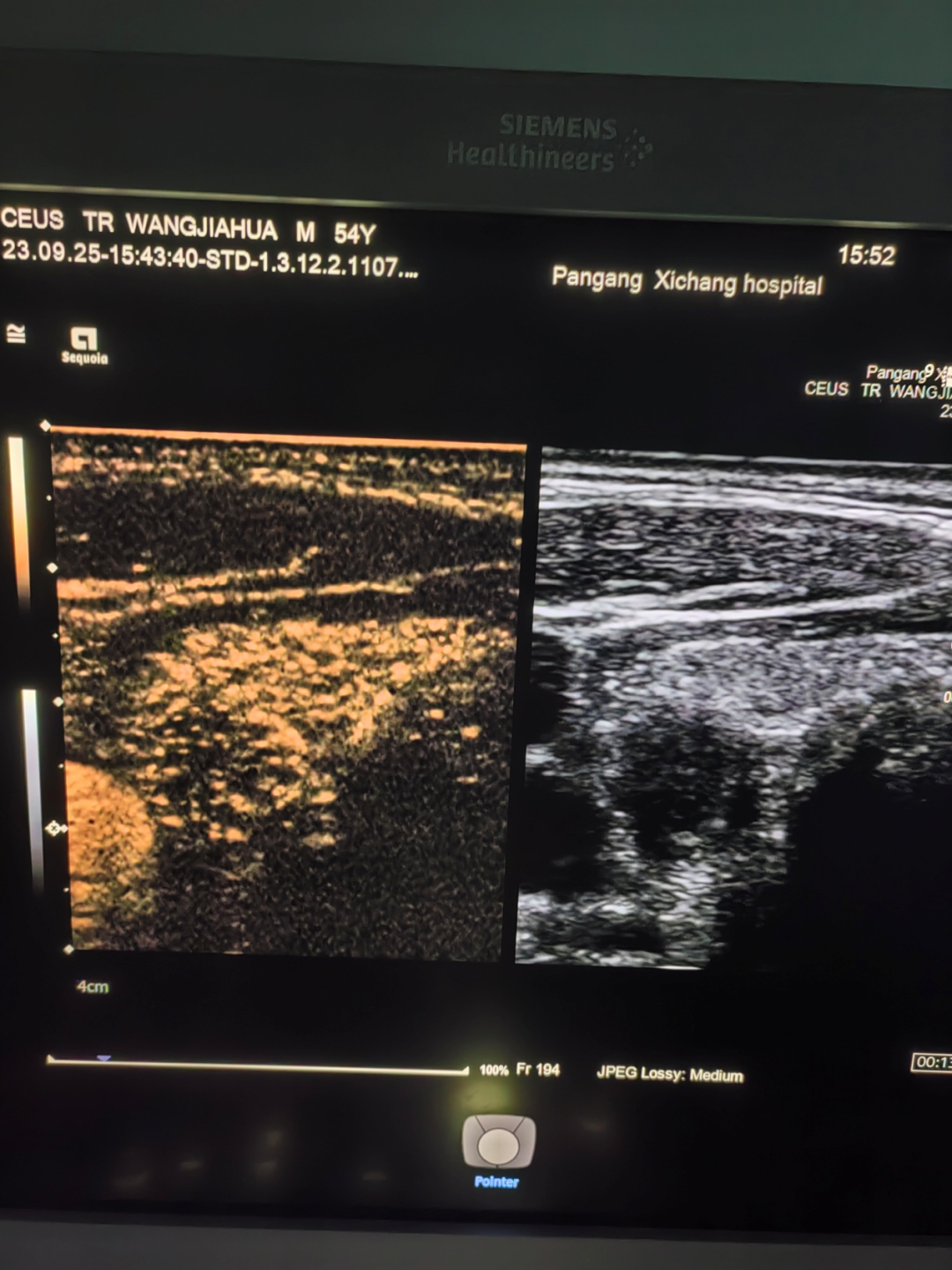 Multimodal Ultrasound Examination of Thyroid and Breast Nodules