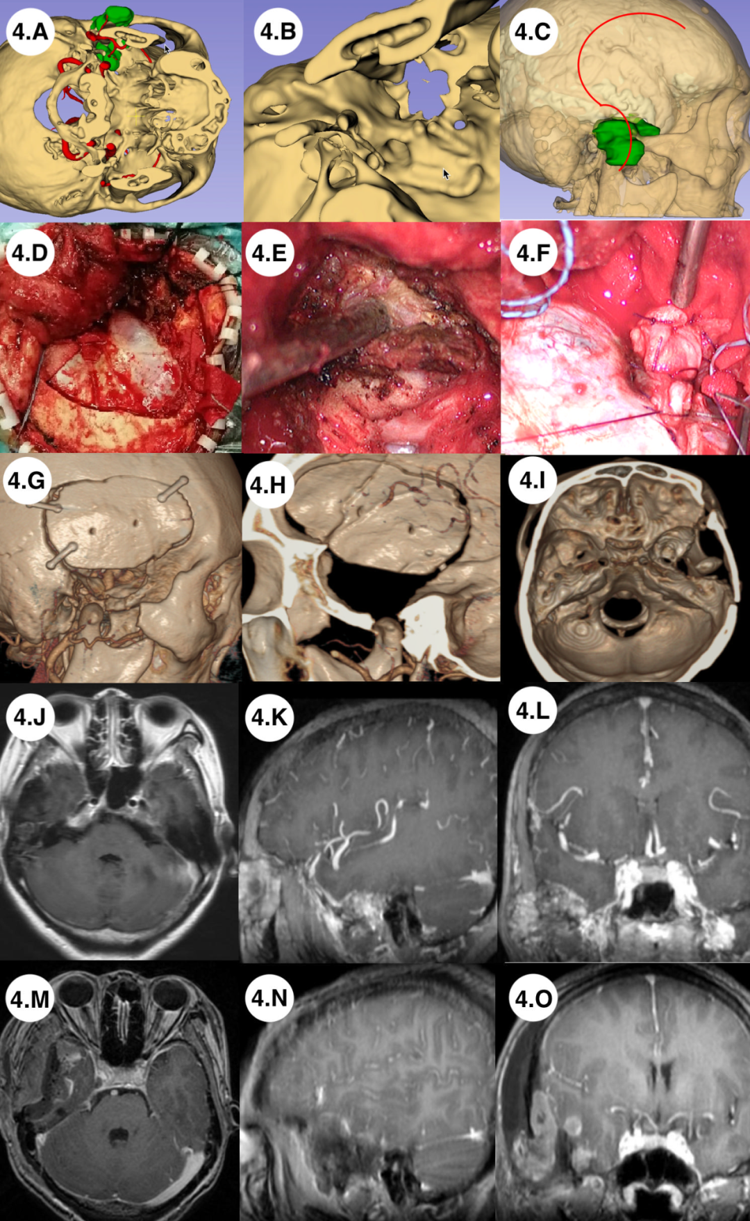 Application of Preoperative Multimodal Imaging Fusion Technology in Complex Skull Base Tumor Surgery