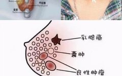 Multimodal Ultrasound Examination of Thyroid and Breast Nodules