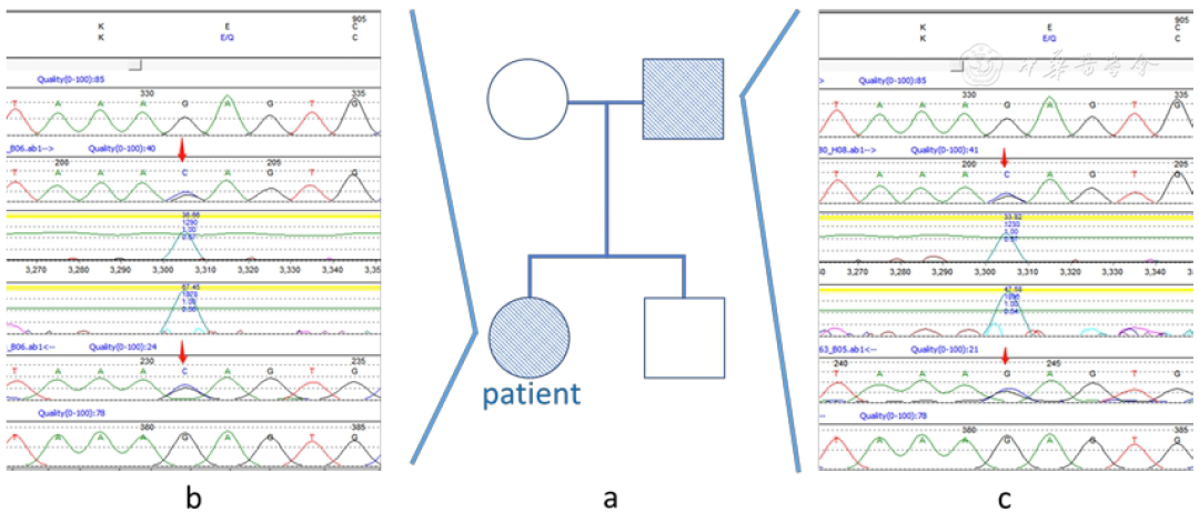 Case Report: Hemophagocytic Lymphohistiocytosis with Rag1 Gene Mutation