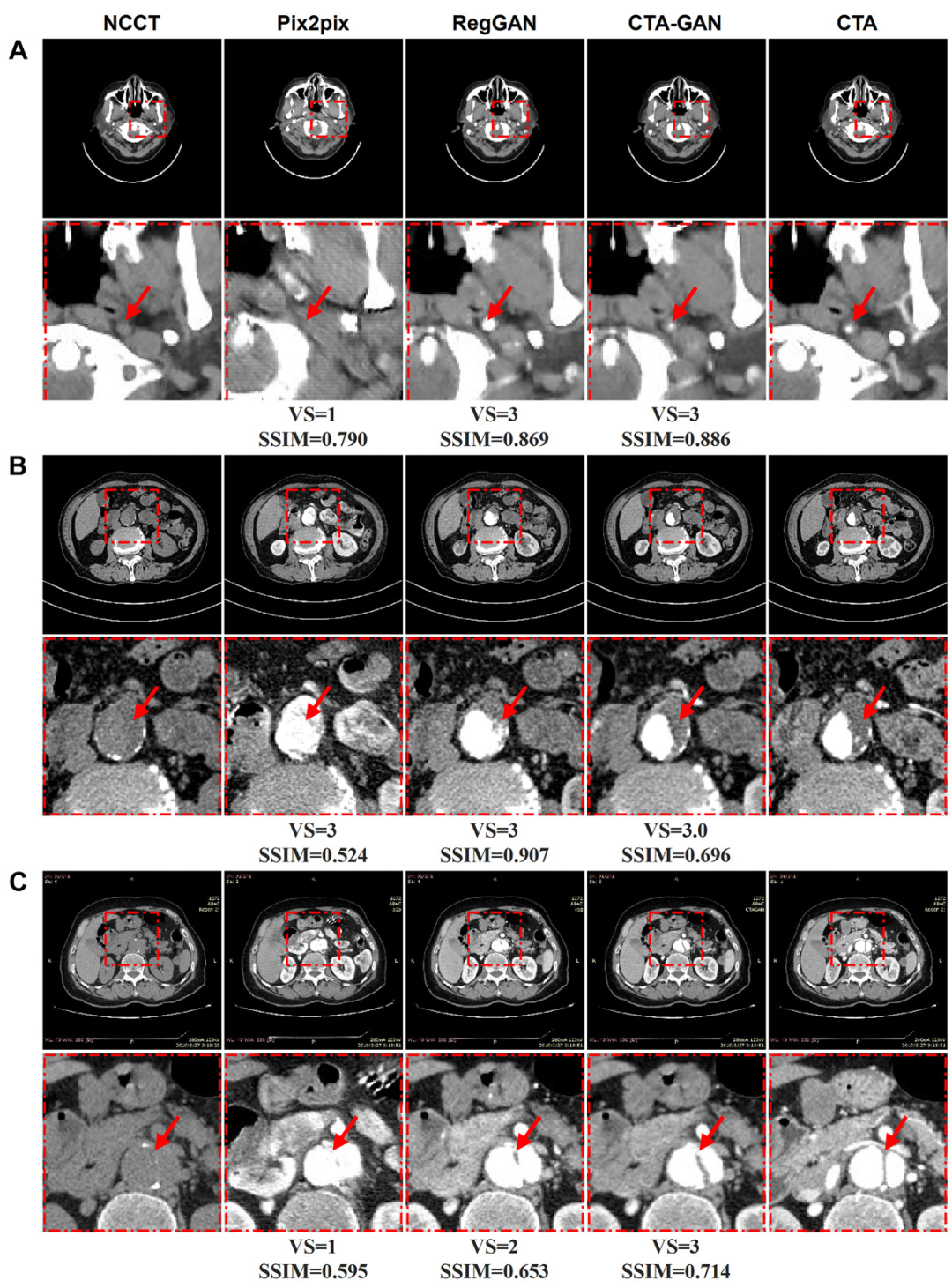 Non-Contrast Agent CTA Imaging Breakthrough