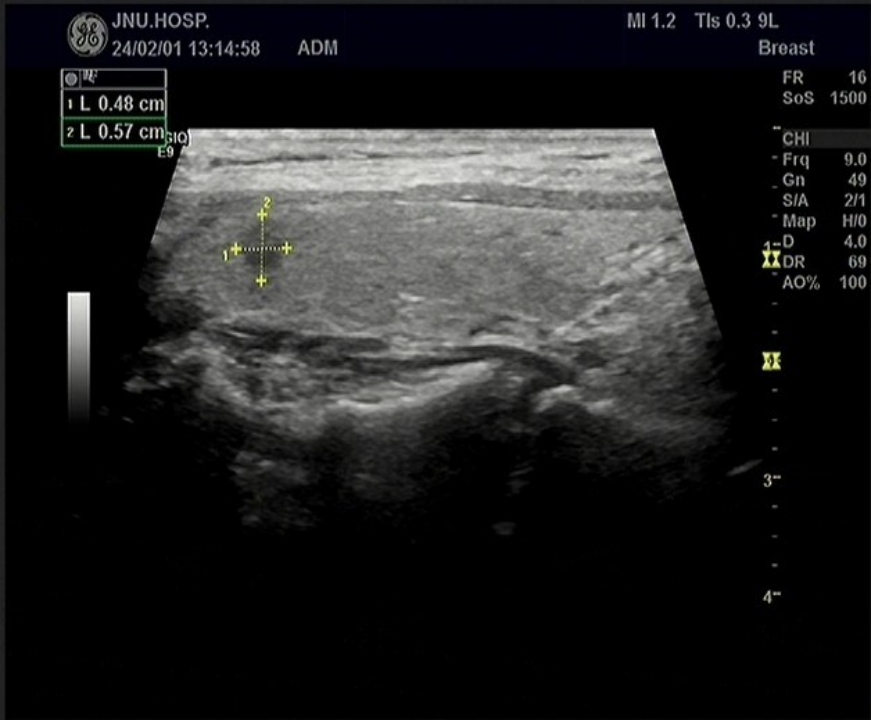 Multimodal Ultrasound Evaluation of Thyroid Nodules