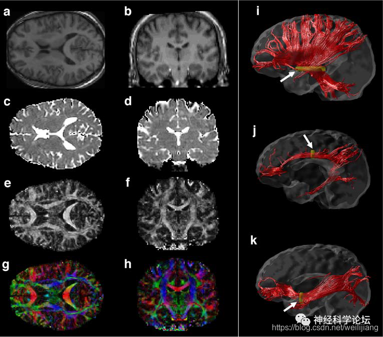 New Imaging Technology: Diffusion Tensor Imaging (DTI)
