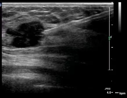Multimodal Ultrasound Examination of Thyroid and Breast Nodules
