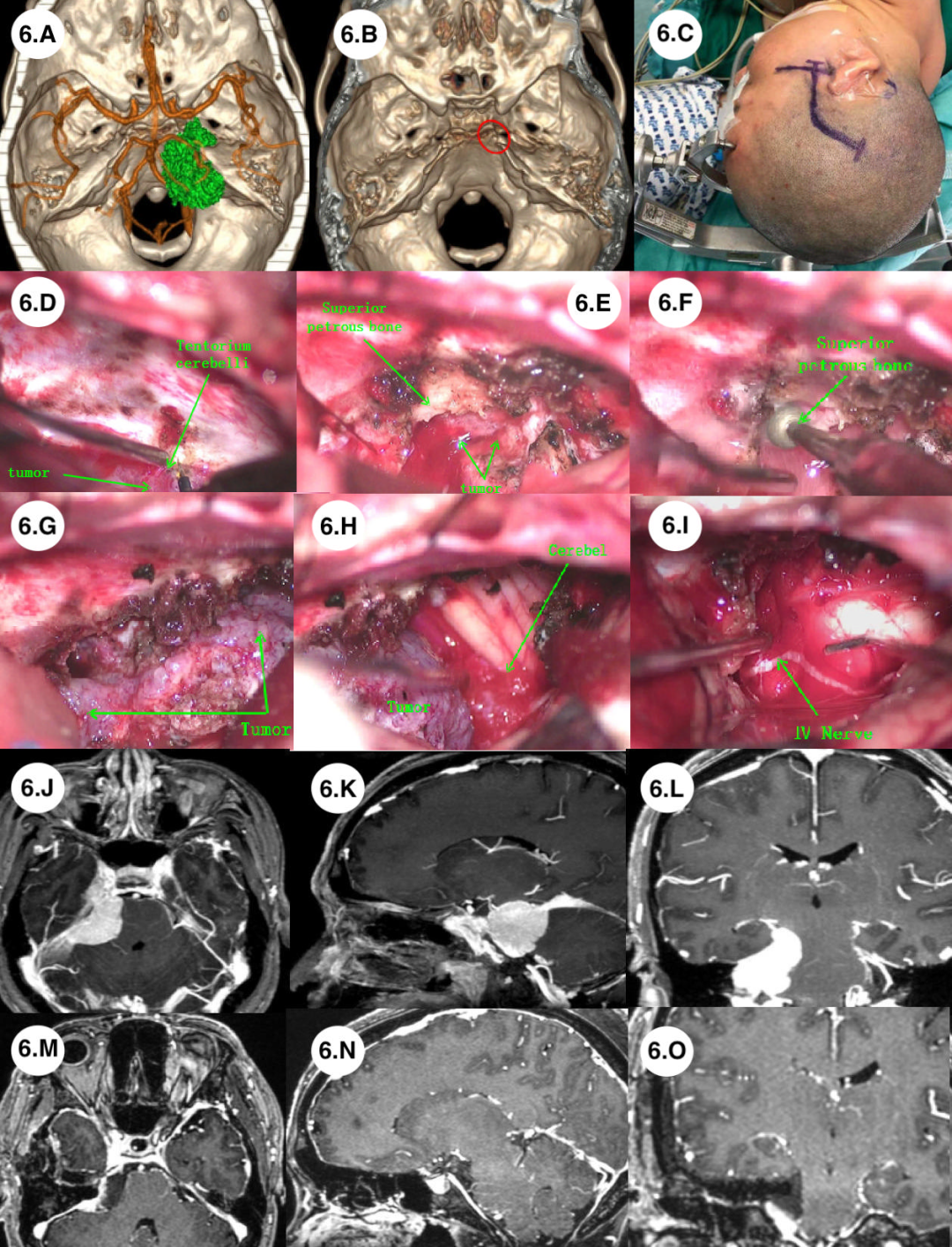 Application of Preoperative Multimodal Imaging Fusion Technology in Complex Skull Base Tumor Surgery
