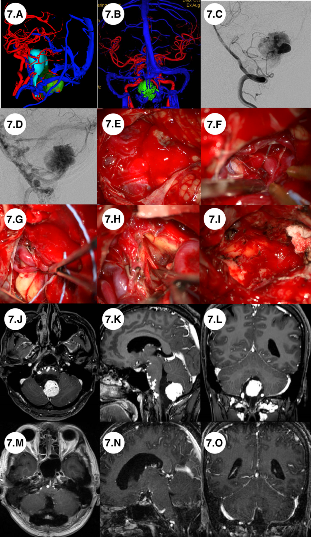 Application of Preoperative Multimodal Imaging Fusion Technology in Complex Skull Base Tumor Surgery