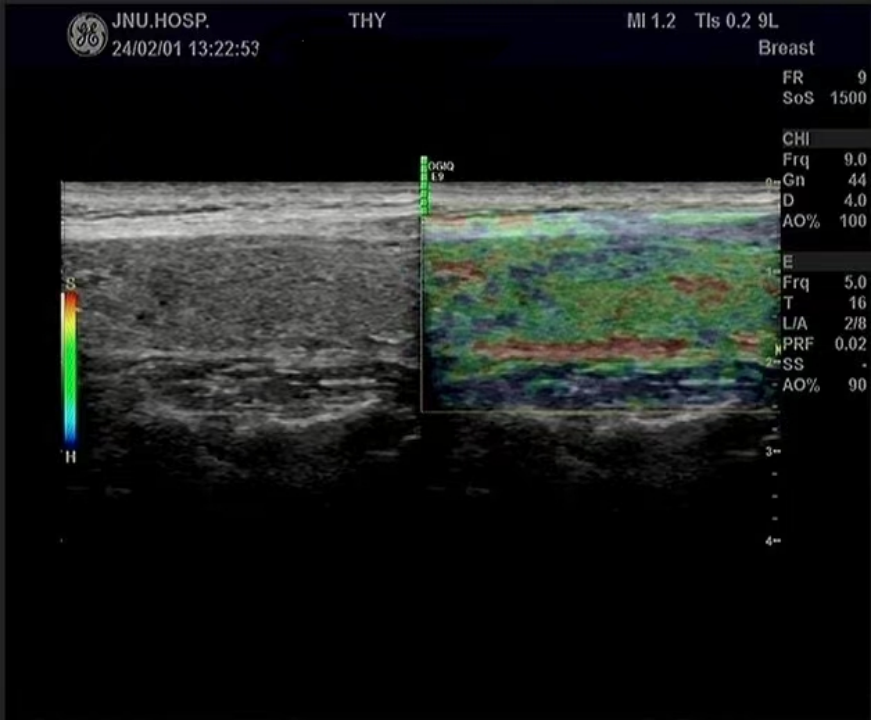 Multimodal Ultrasound Evaluation of Thyroid Nodules