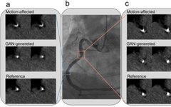 Motion Artifact Correction in Coronary CT Angiography Using GAN