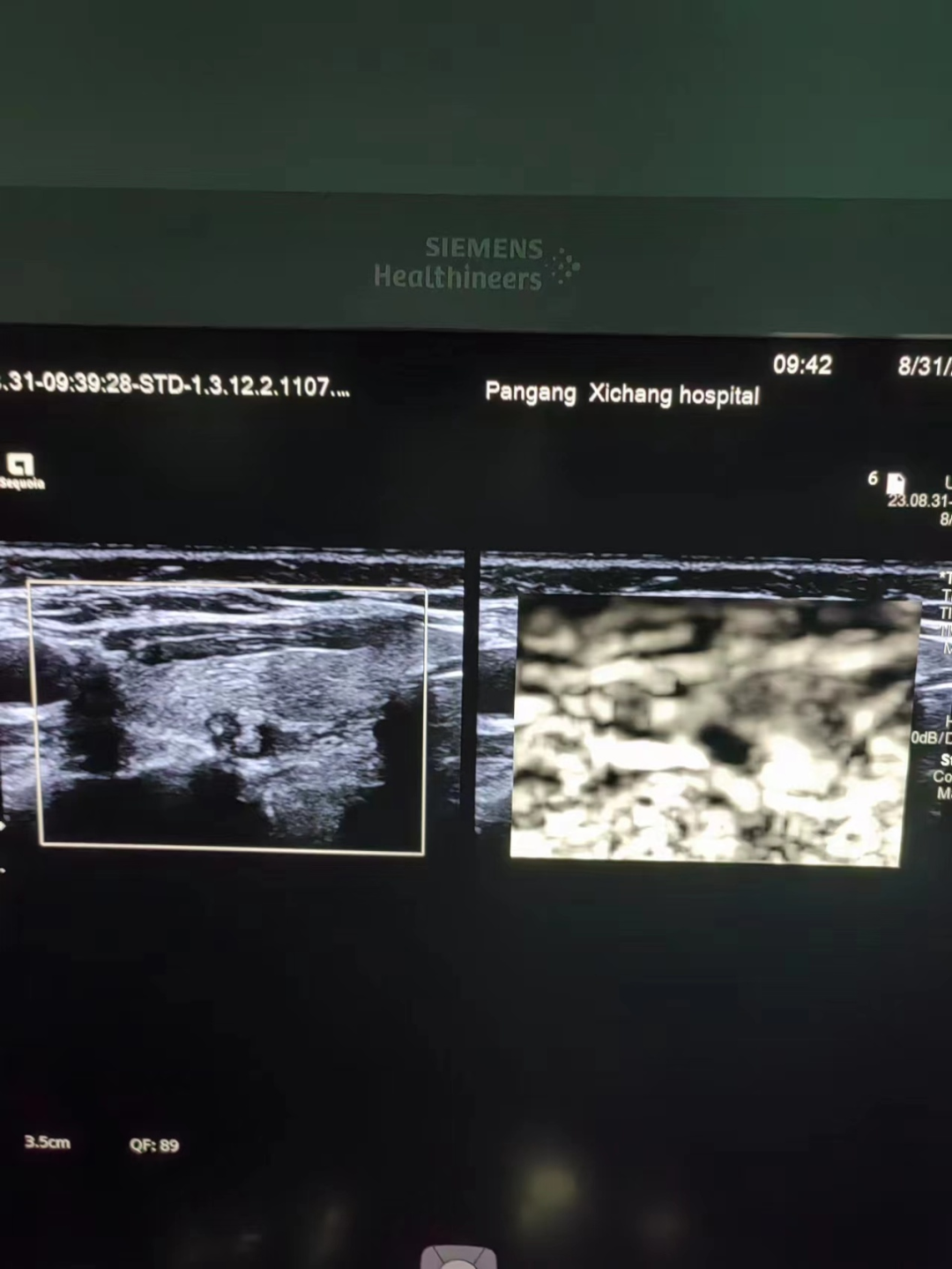 Multimodal Ultrasound Examination of Thyroid and Breast Nodules