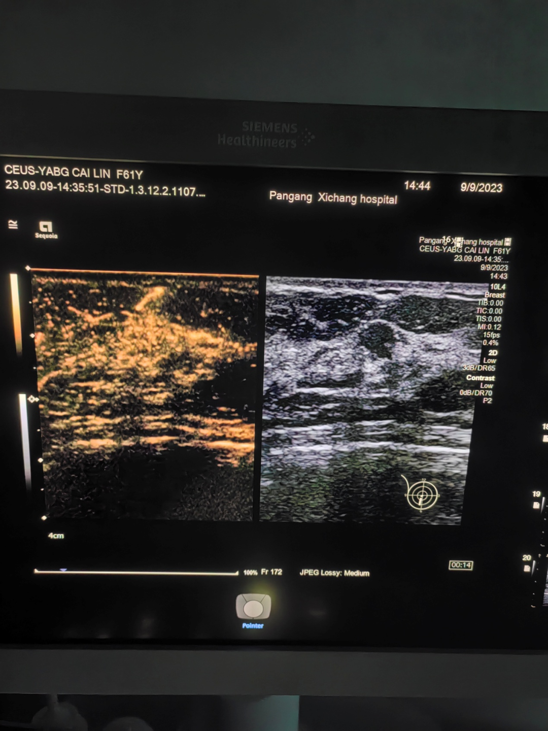 Multimodal Ultrasound Examination of Thyroid and Breast Nodules