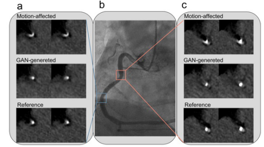 Motion Artifact Correction in Coronary CT Angiography Using GAN