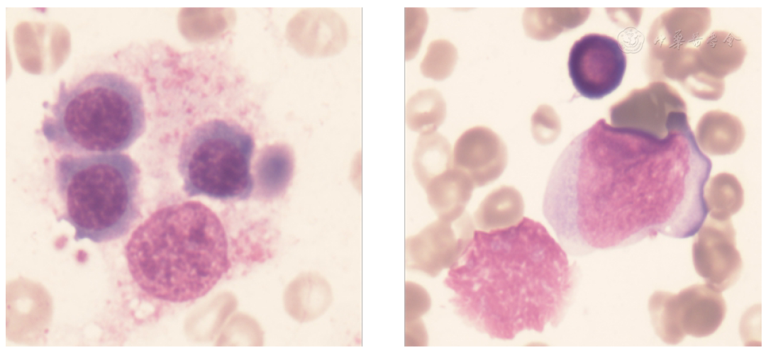 Case Report: Hemophagocytic Lymphohistiocytosis with Rag1 Gene Mutation