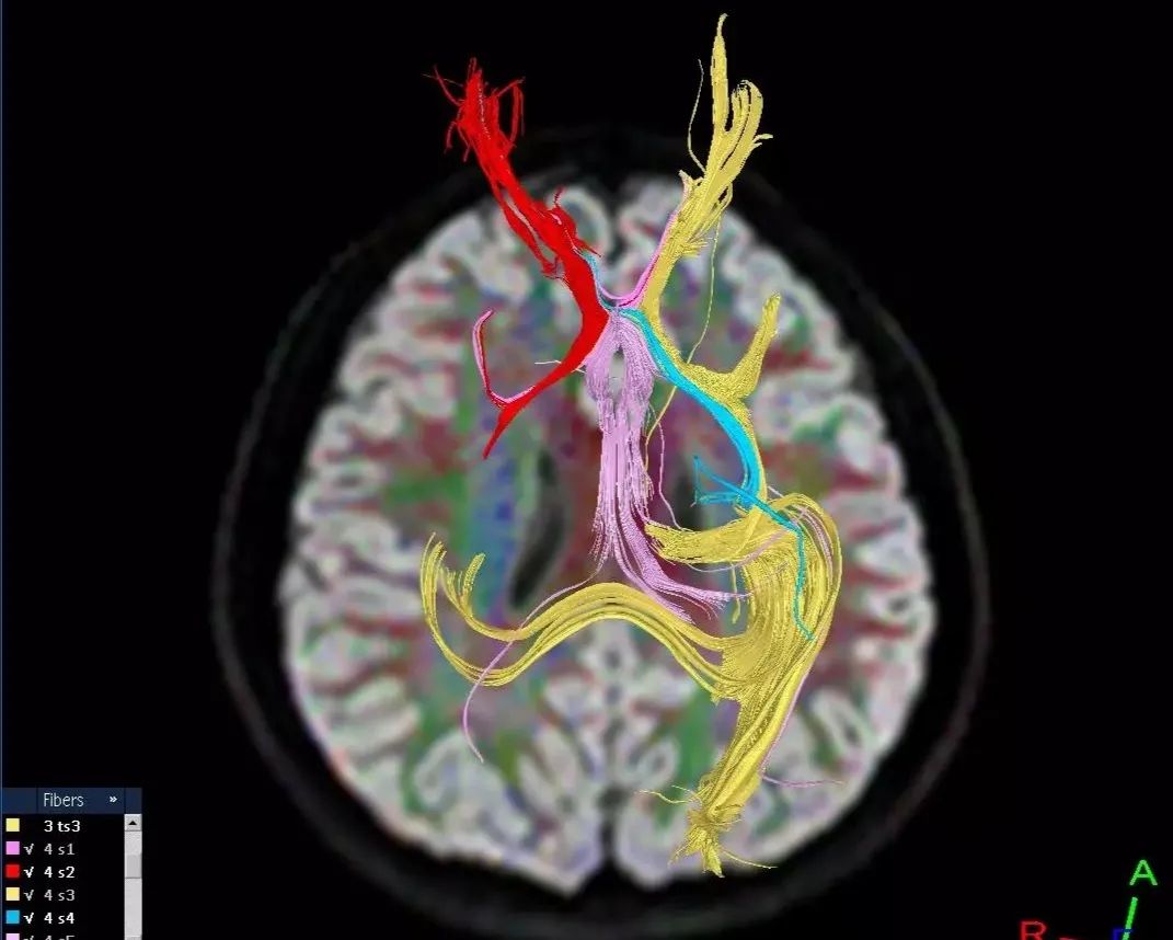 Diffusion Tensor Imaging (DTI)