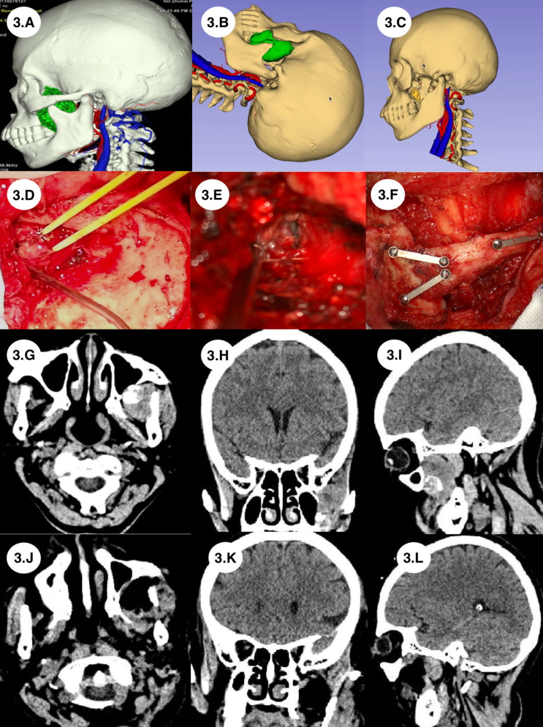Application of Preoperative Multimodal Imaging Fusion Technology in Complex Skull Base Tumor Surgery