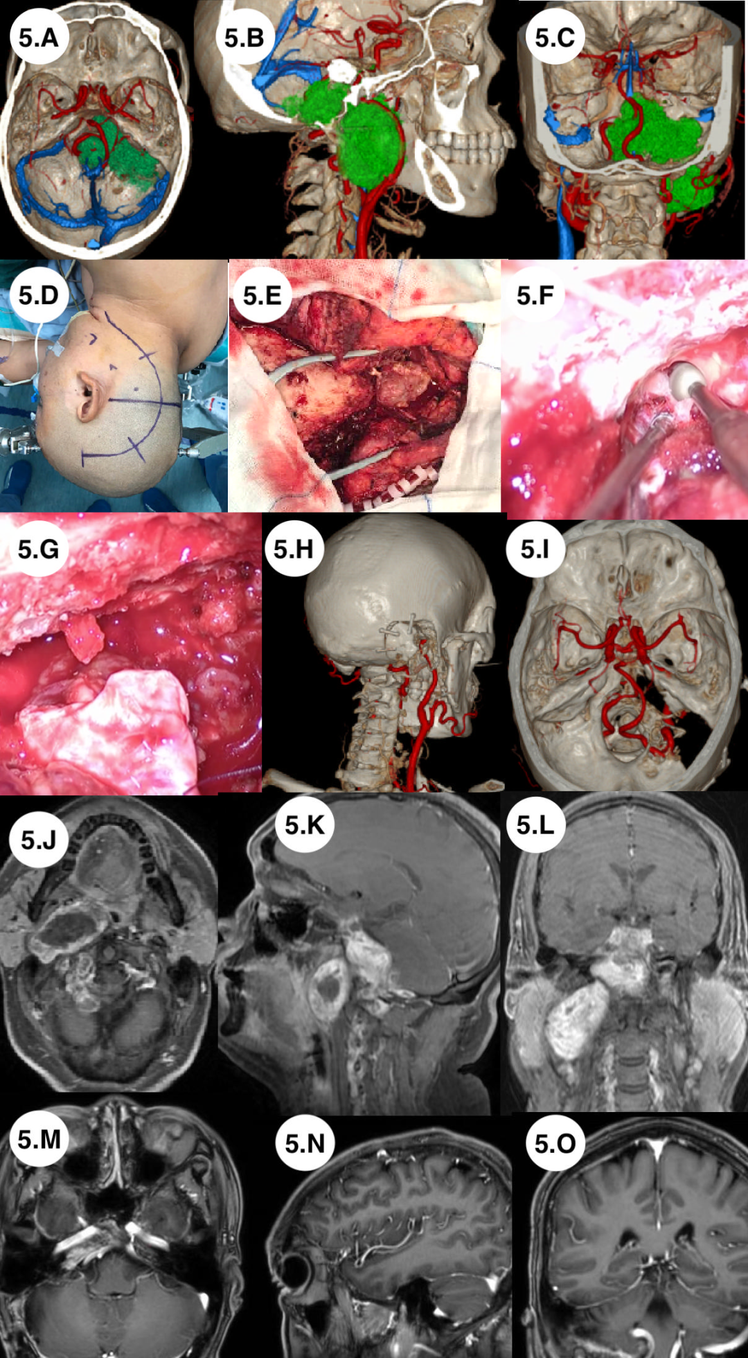 Application of Preoperative Multimodal Imaging Fusion Technology in Complex Skull Base Tumor Surgery