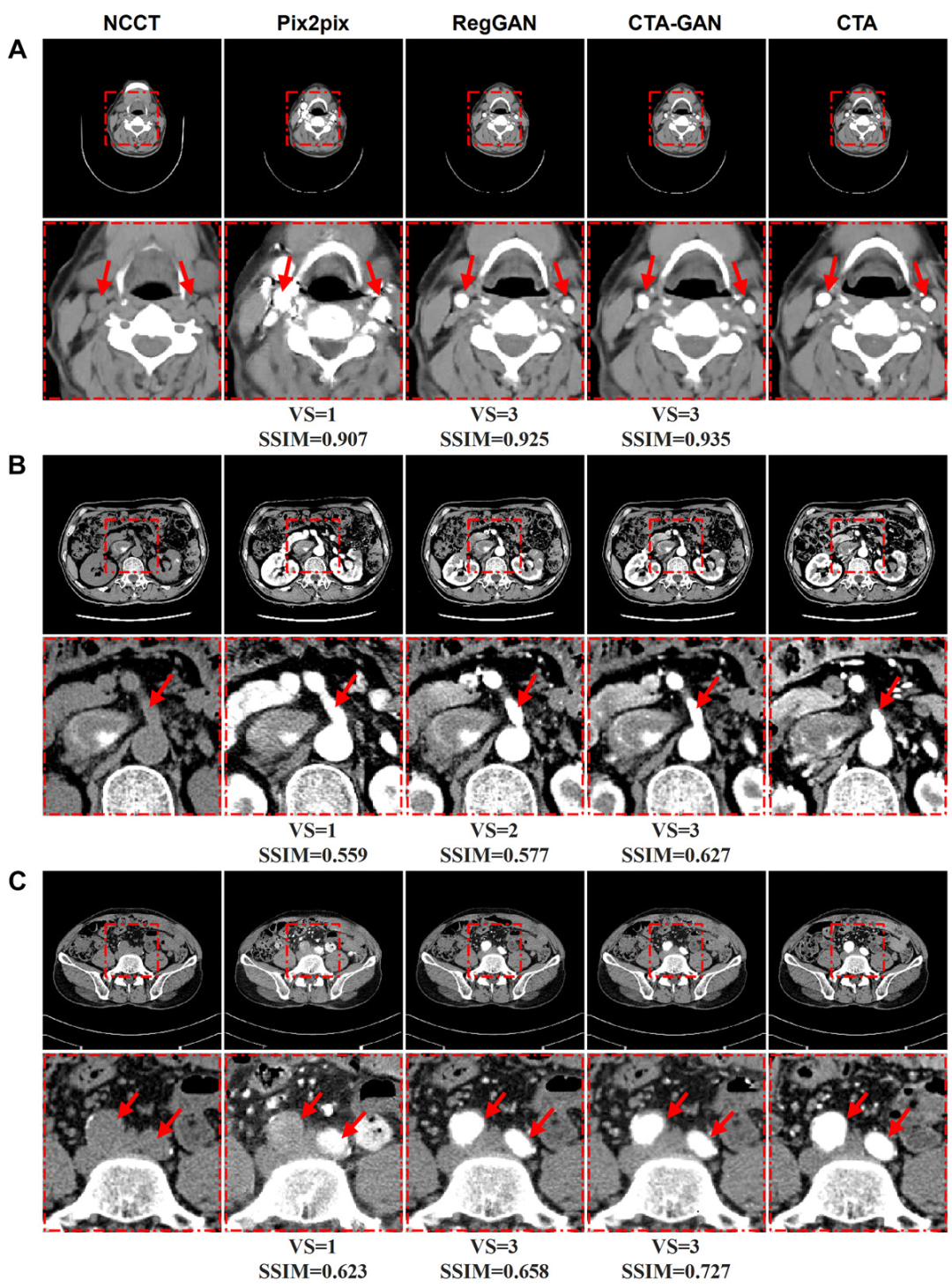 Non-Contrast Agent CTA Imaging Breakthrough