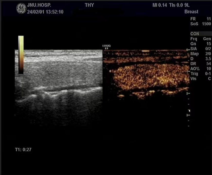 Multimodal Ultrasound Evaluation of Thyroid Nodules